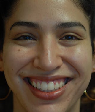 Rhinoplasty Before & After Gallery - Patient 234570 - Image 12