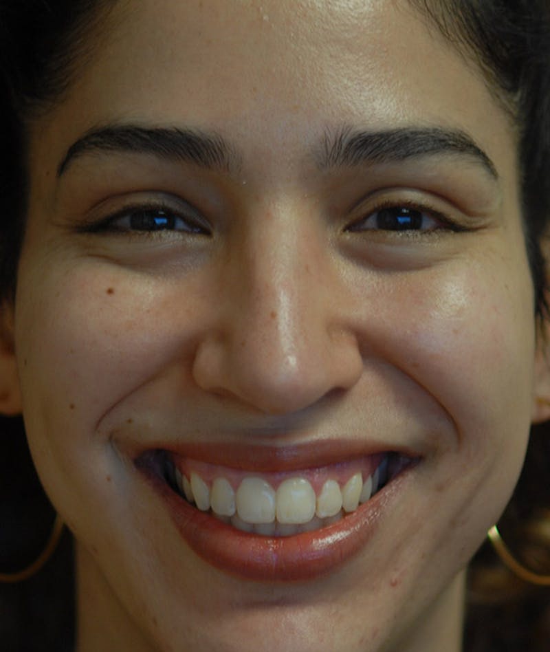 Rhinoplasty Before & After Gallery - Patient 234570 - Image 12