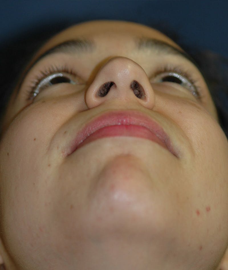 Rhinoplasty Before & After Gallery - Patient 234570 - Image 13