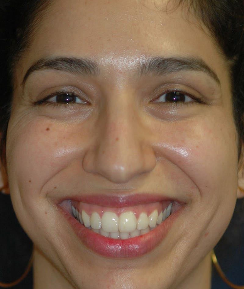 Rhinoplasty Before & After Gallery - Patient 234570 - Image 11