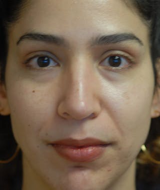 Rhinoplasty Before & After Gallery - Patient 234570 - Image 10