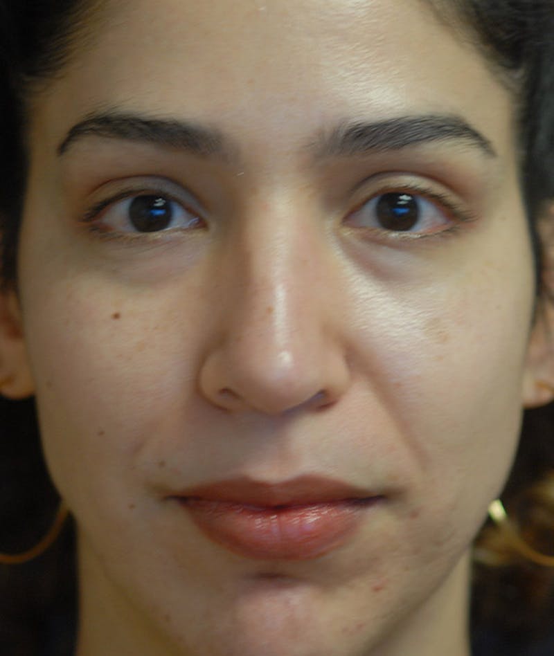 Rhinoplasty Before & After Gallery - Patient 234570 - Image 10