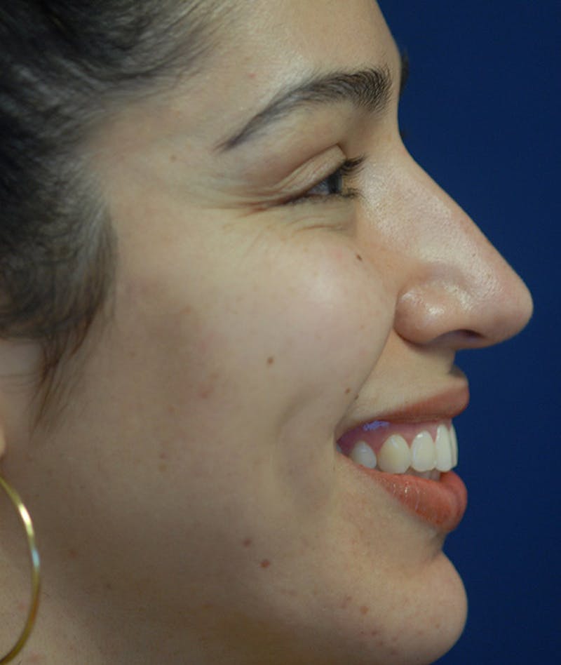 Rhinoplasty Before & After Gallery - Patient 234570 - Image 8