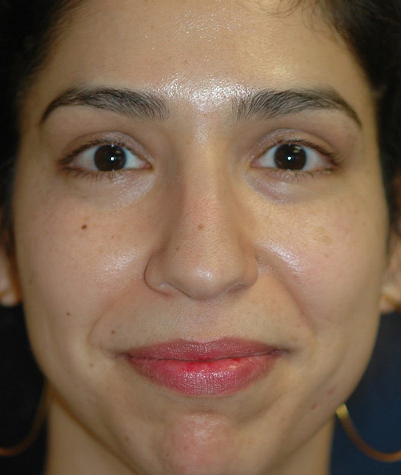 Rhinoplasty Before & After Gallery - Patient 234570 - Image 9