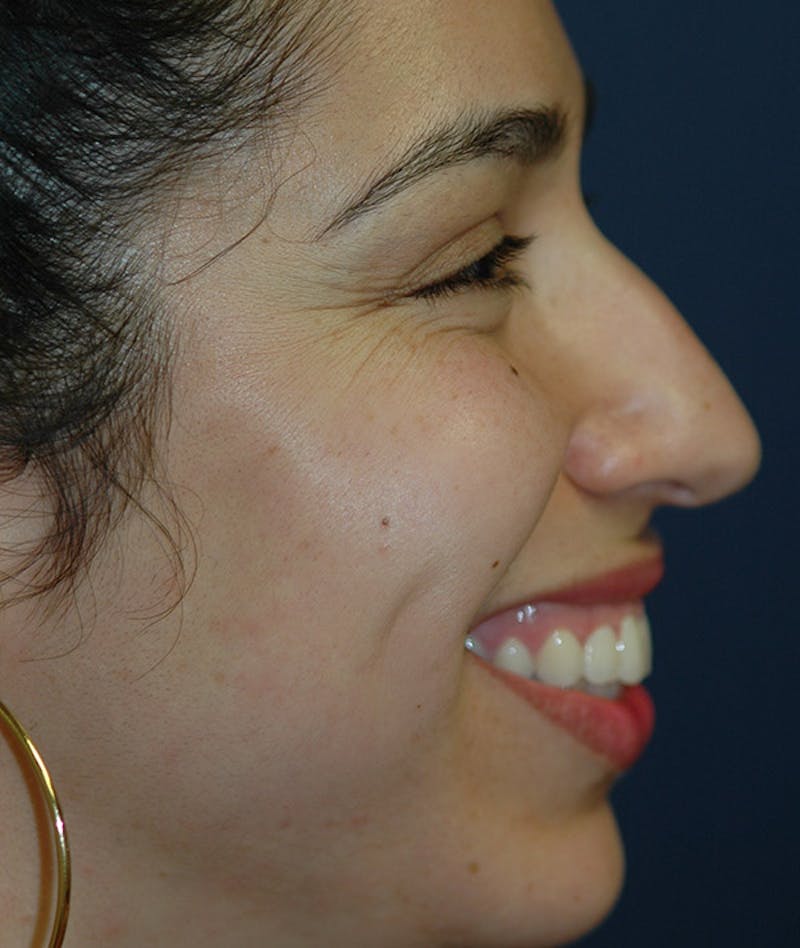 Rhinoplasty Before & After Gallery - Patient 234570 - Image 7