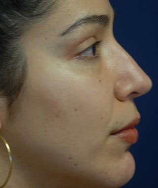 Rhinoplasty Before & After Gallery - Patient 234570 - Image 6