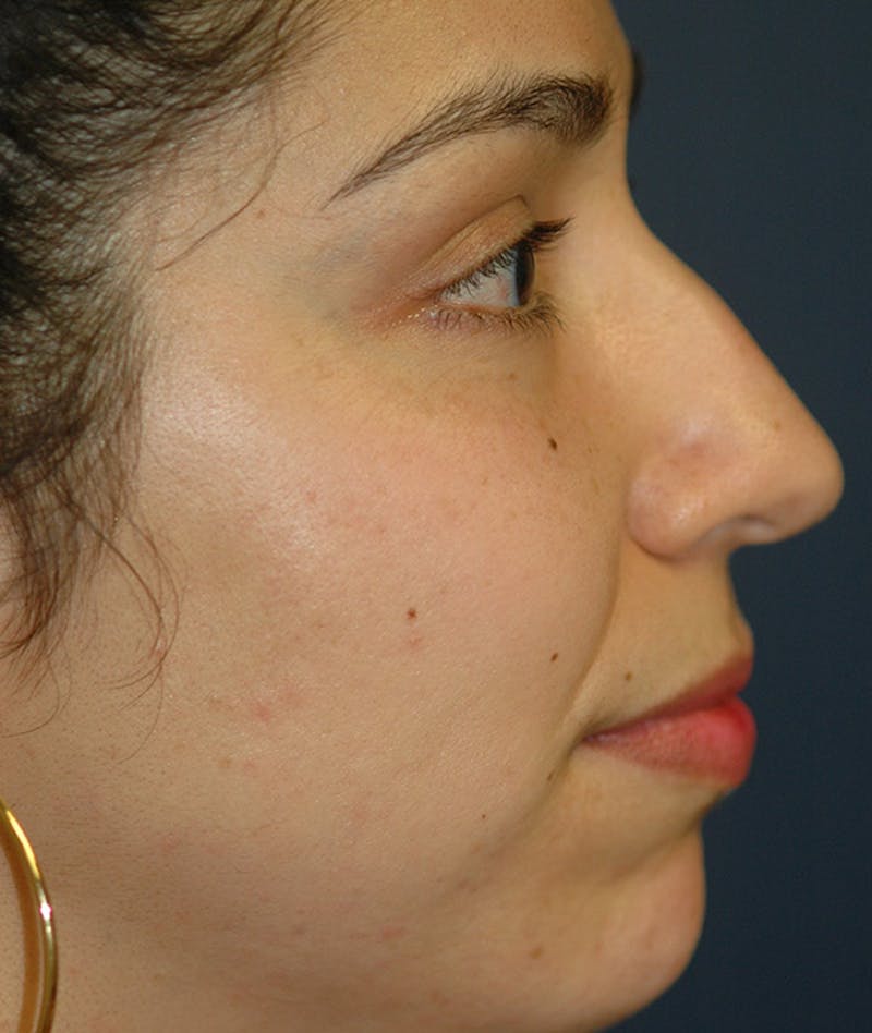 Rhinoplasty Before & After Gallery - Patient 234570 - Image 5