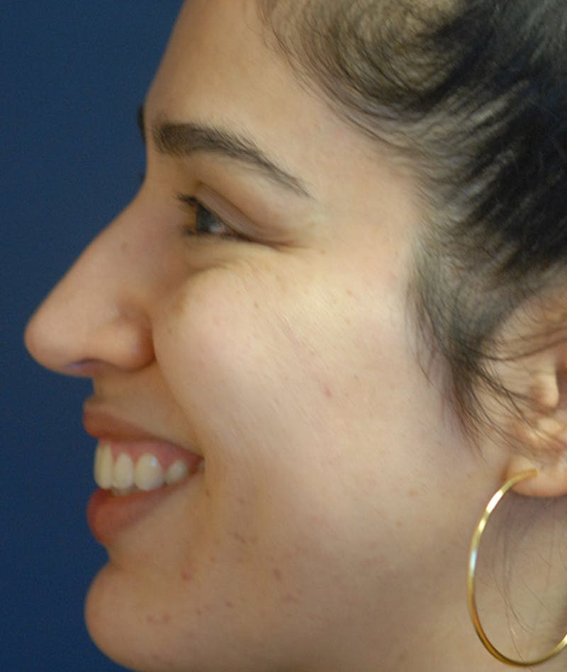 Rhinoplasty Before & After Gallery - Patient 234570 - Image 4