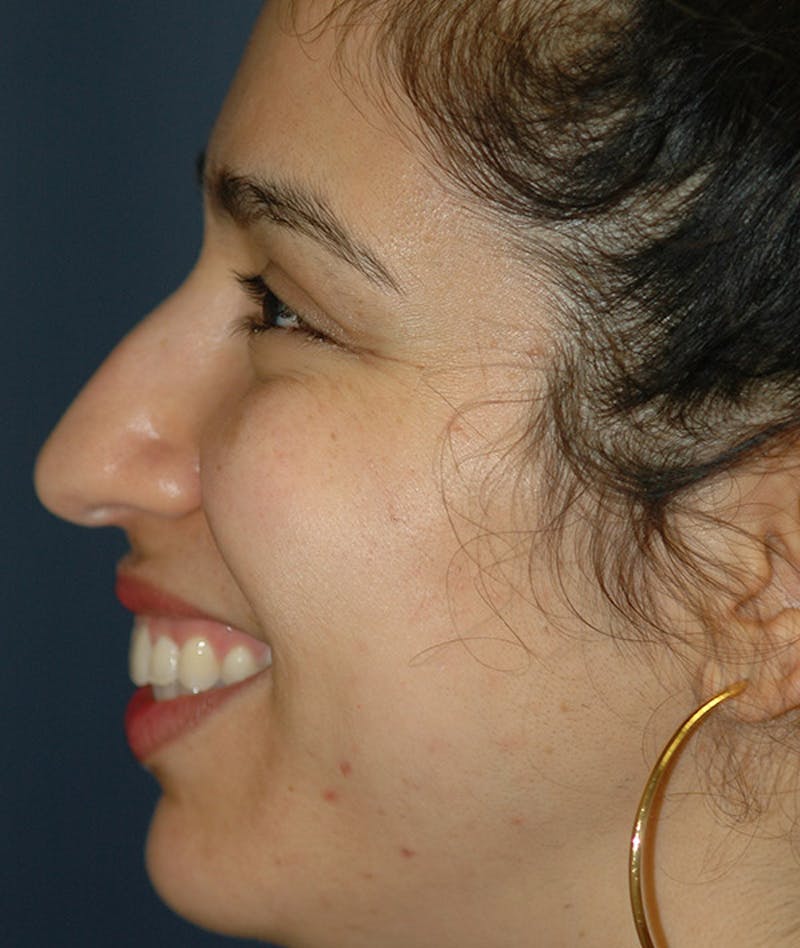 Rhinoplasty Before & After Gallery - Patient 234570 - Image 3