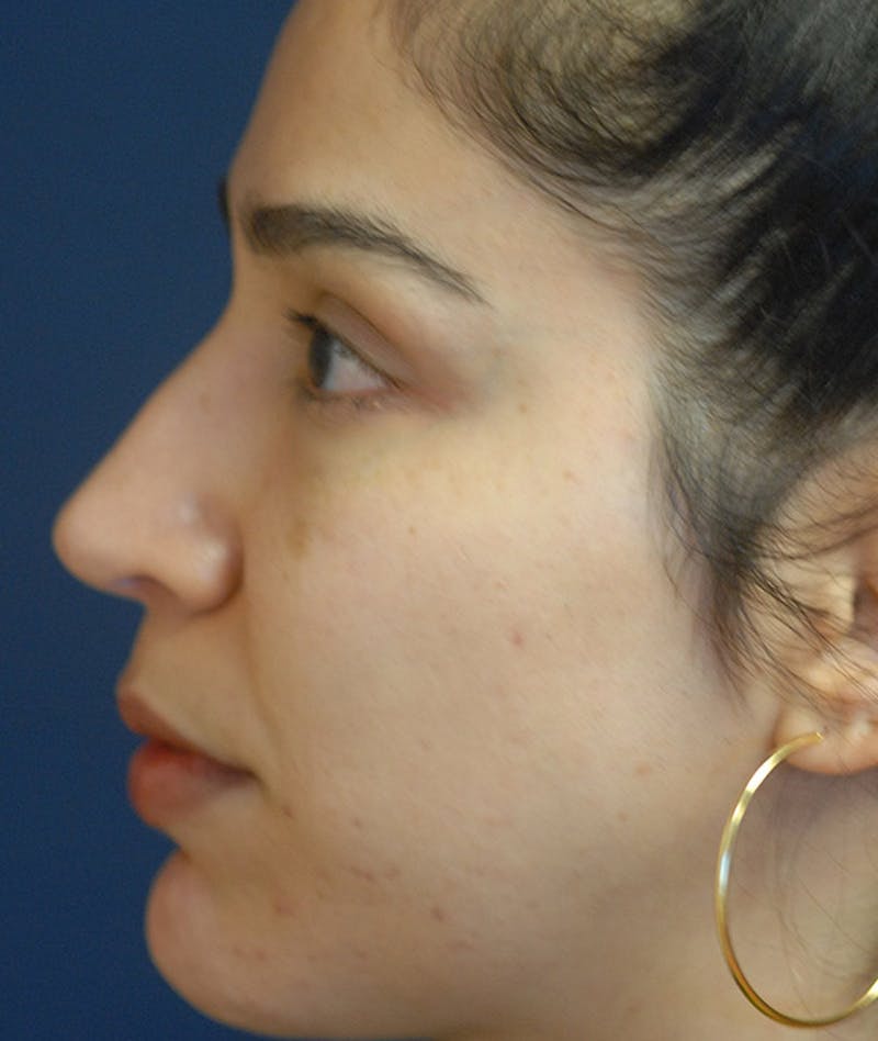 Rhinoplasty Before & After Gallery - Patient 234570 - Image 2