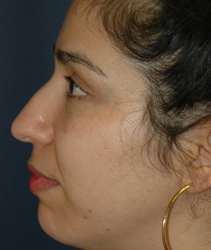 Rhinoplasty Before & After Gallery - Patient 234570 - Image 1