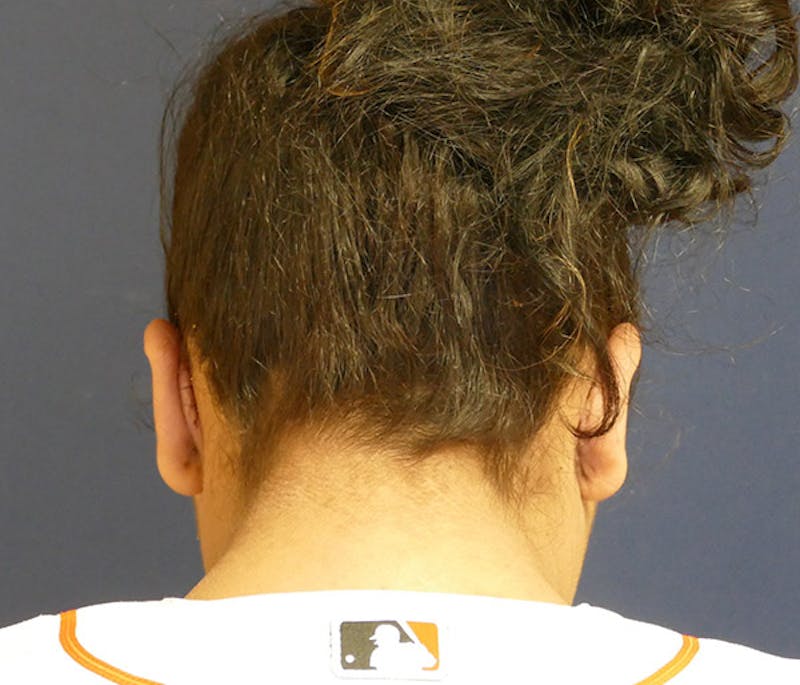 Ear Pinning (Otoplasty) Before & After Gallery - Patient 220714 - Image 8