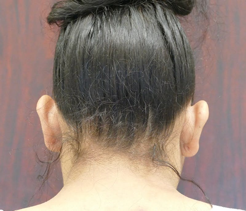 Ear Pinning (Otoplasty) Before & After Gallery - Patient 220714 - Image 7
