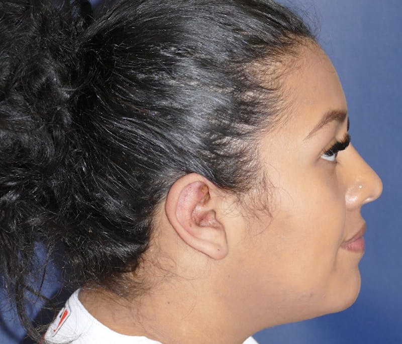 Ear Pinning (Otoplasty) Before & After Gallery - Patient 220714 - Image 6
