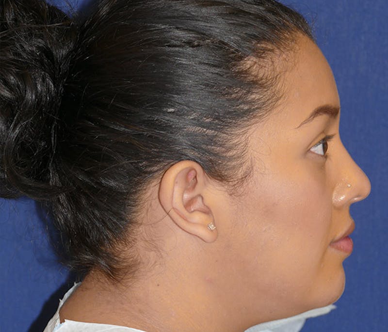 Ear Pinning (Otoplasty) Before & After Gallery - Patient 220714 - Image 5