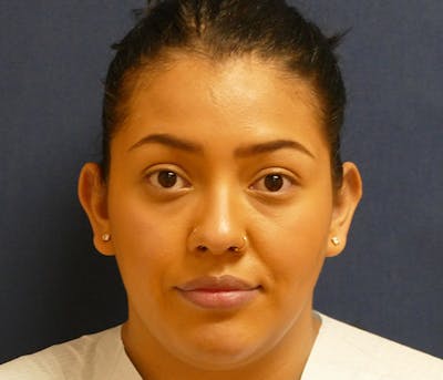Ear Pinning (Otoplasty) Before & After Gallery - Patient 220714 - Image 1