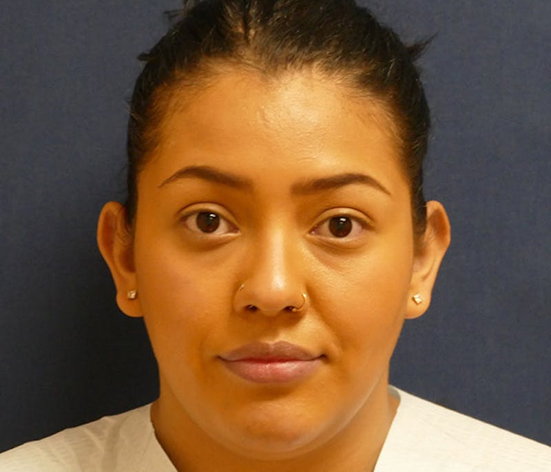 Ear Pinning (Otoplasty) Before & After Gallery - Patient 220714 - Image 1