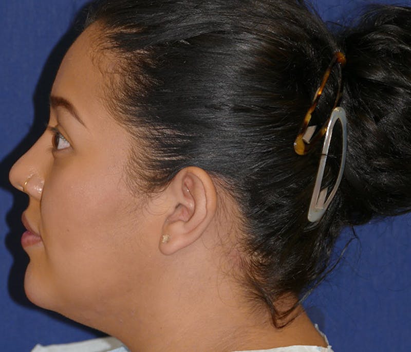 Ear Pinning (Otoplasty) Before & After Gallery - Patient 220714 - Image 3