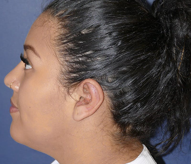 Ear Pinning (Otoplasty) Before & After Gallery - Patient 220714 - Image 4