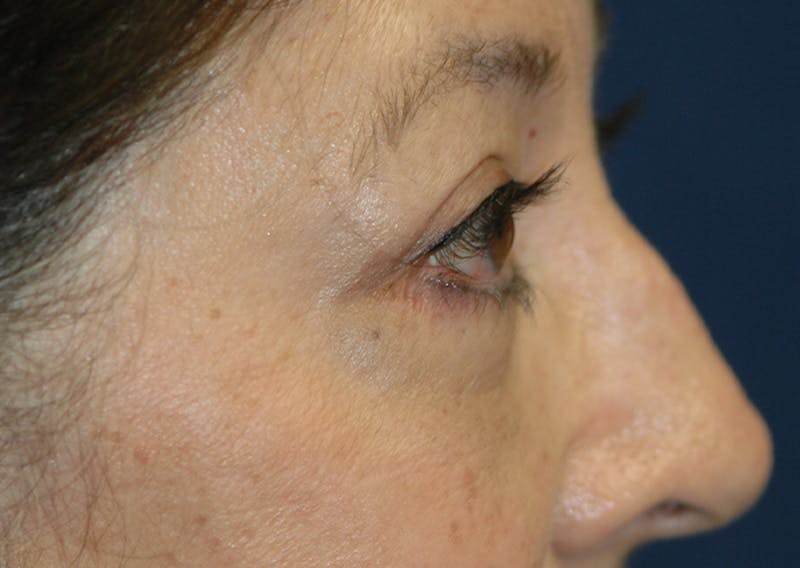 Eyelid Lift (Blepharoplasty) Before & After Gallery - Patient 393831 - Image 10