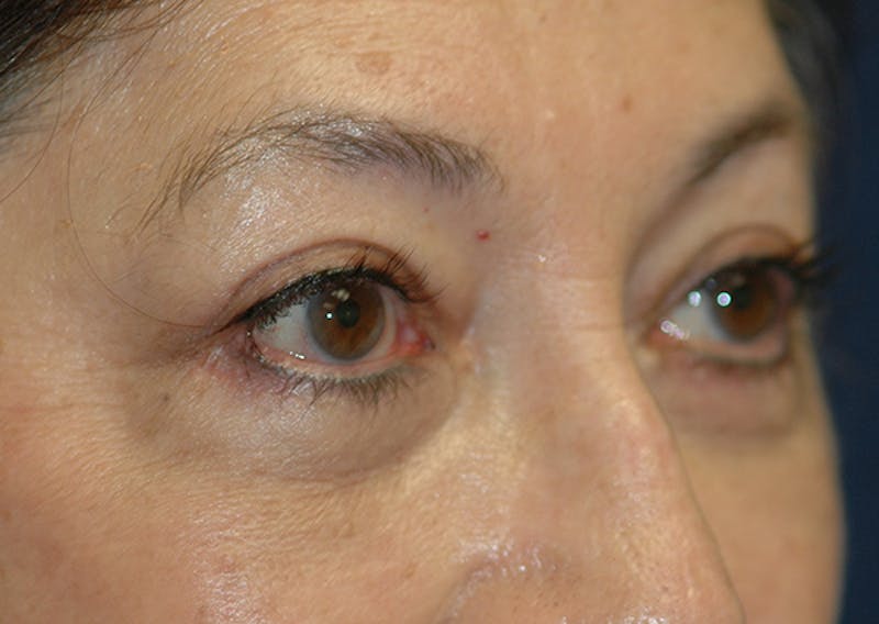 Eyelid Lift (Blepharoplasty) Before & After Gallery - Patient 393831 - Image 8