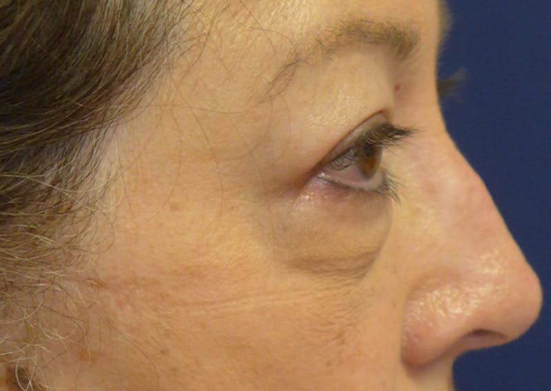 Eyelid Lift (Blepharoplasty) Before & After Gallery - Patient 393831 - Image 9