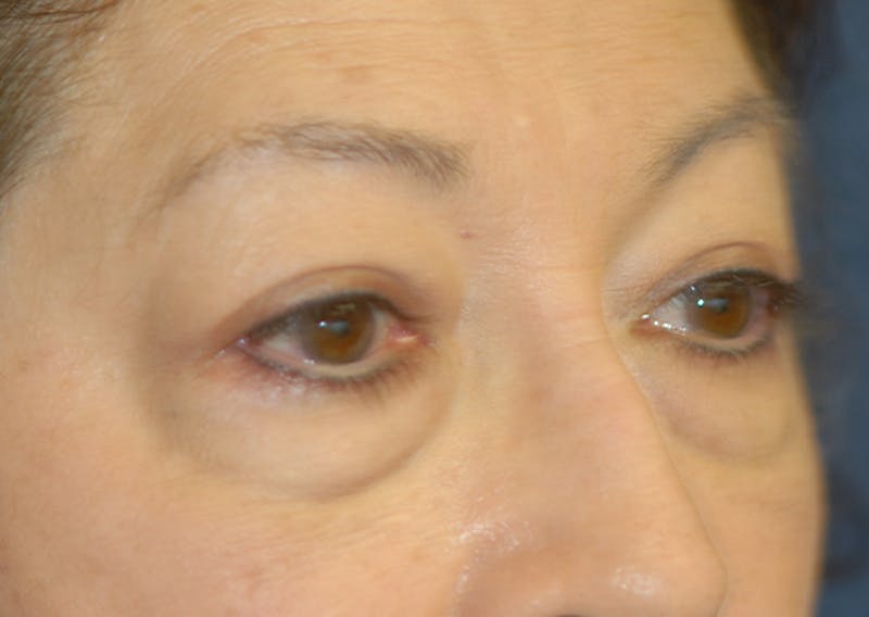 Eyelid Lift (Blepharoplasty) Before & After Gallery - Patient 393831 - Image 7