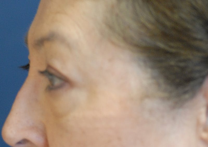 Eyelid Lift (Blepharoplasty) Before & After Gallery - Patient 393831 - Image 5