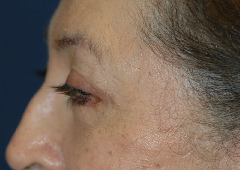 Eyelid Lift (Blepharoplasty) Before & After Gallery - Patient 393831 - Image 6