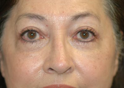Eyelid Lift (Blepharoplasty) Before & After Gallery - Patient 393831 - Image 2