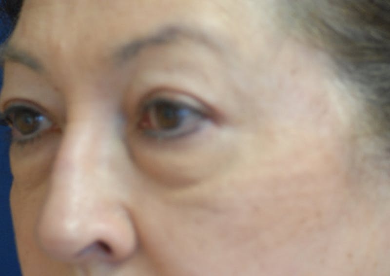Eyelid Lift (Blepharoplasty) Before & After Gallery - Patient 393831 - Image 3