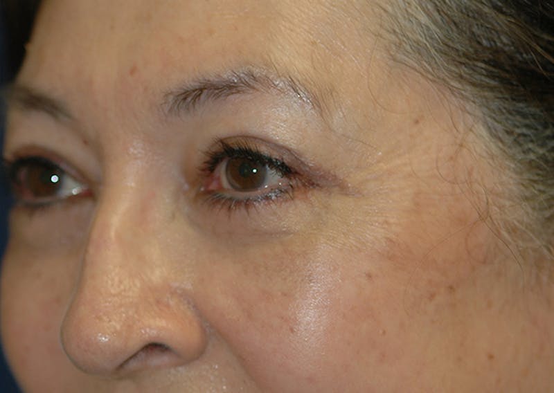 Eyelid Lift (Blepharoplasty) Before & After Gallery - Patient 393831 - Image 4
