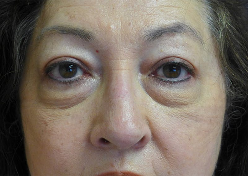 Eyelid Lift (Blepharoplasty) Before & After Gallery - Patient 393831 - Image 1