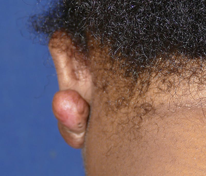 Miscellaneous Before & After Gallery - Patient 379329 - Image 5