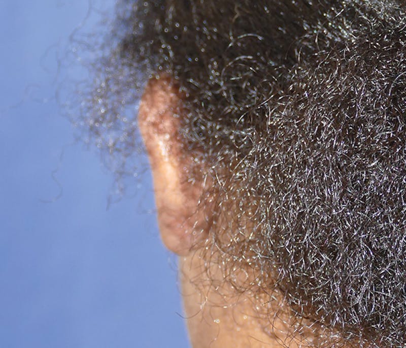 Miscellaneous Before & After Gallery - Patient 379329 - Image 6