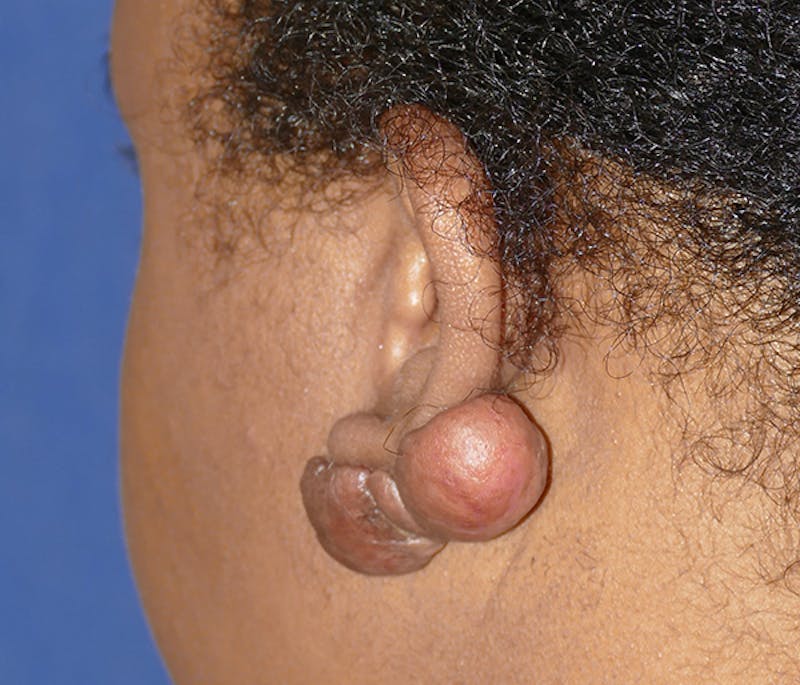 Miscellaneous Before & After Gallery - Patient 379329 - Image 3
