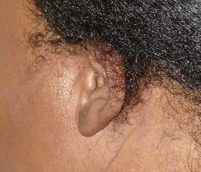 Miscellaneous Before & After Gallery - Patient 379329 - Image 4
