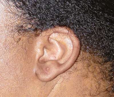 Miscellaneous Before & After Gallery - Patient 379329 - Image 2