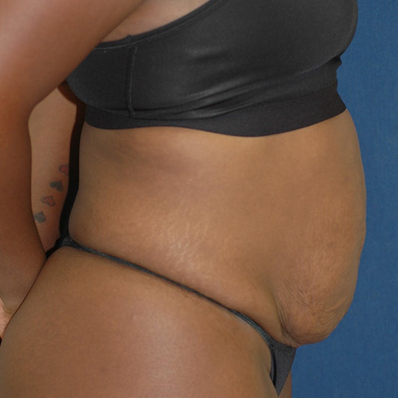 Tummy Tuck (Abdominoplasty) Before & After Gallery - Patient 141228 - Image 7