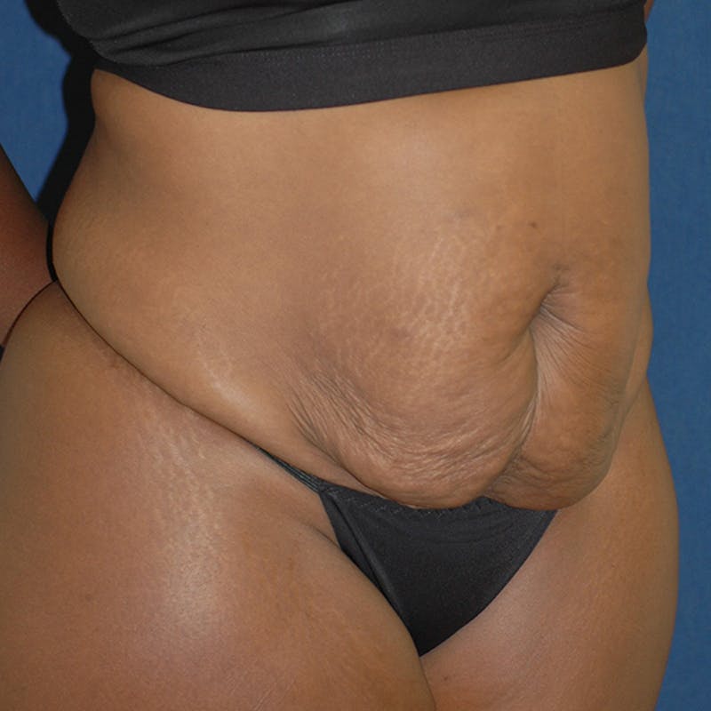 Tummy Tuck (Abdominoplasty) Before & After Gallery - Patient 141228 - Image 5