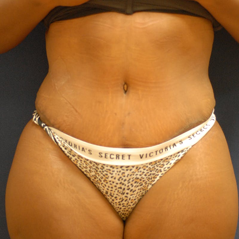 Tummy Tuck (Abdominoplasty) Before & After Gallery - Patient 141228 - Image 2