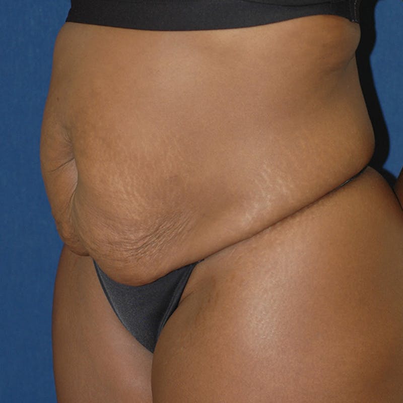 Tummy Tuck (Abdominoplasty) Before & After Gallery - Patient 141228 - Image 3