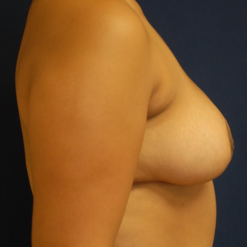Breast Reduction Before & After Gallery - Patient 190541 - Image 8