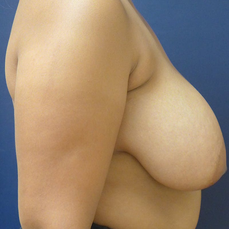 Breast Reduction Before & After Gallery - Patient 190541 - Image 7