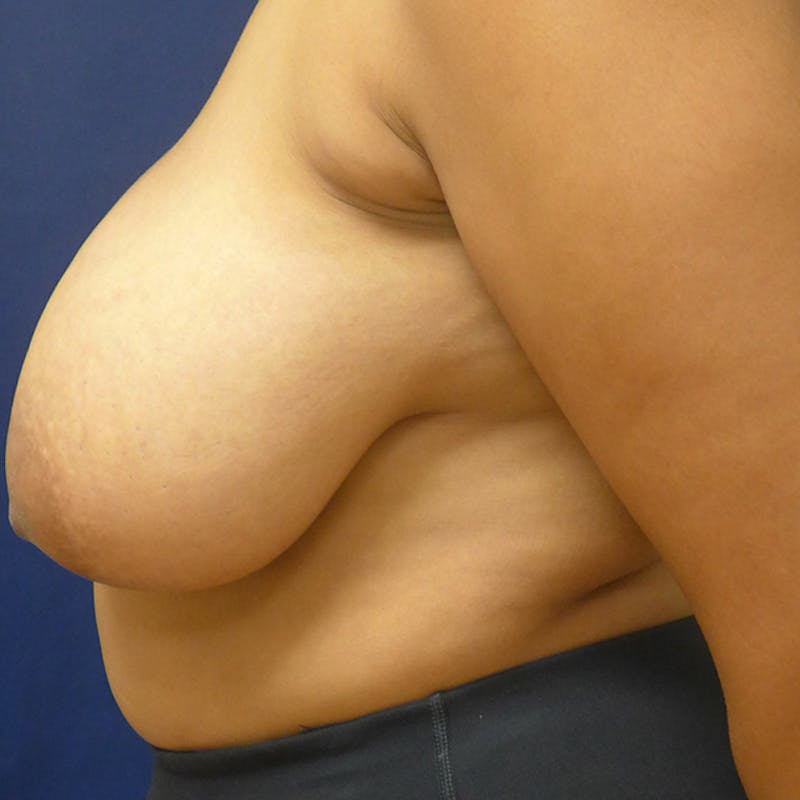 Breast Reduction Before & After Gallery - Patient 190541 - Image 3