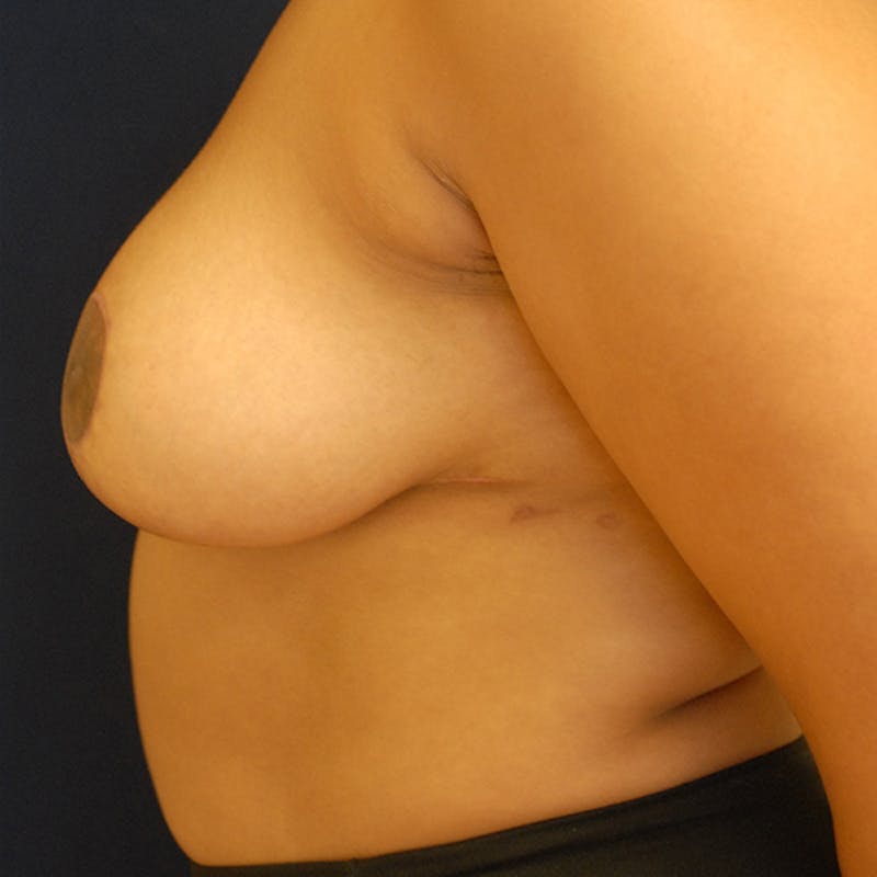 Breast Reduction Before & After Gallery - Patient 190541 - Image 4