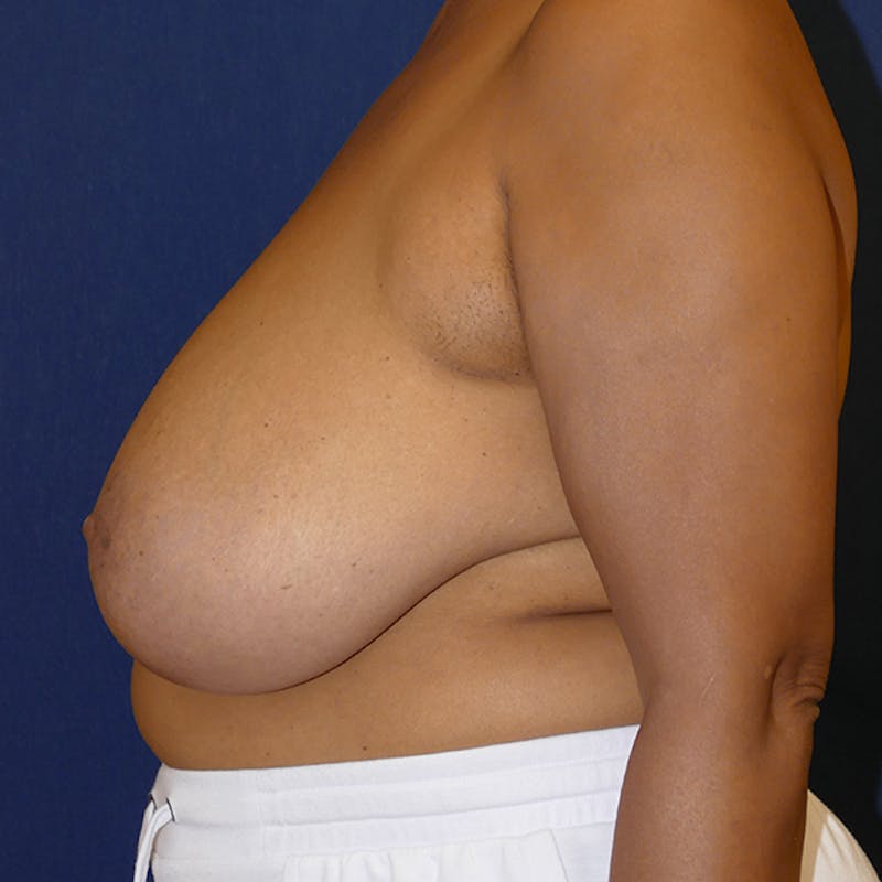 Breast Reduction Before & After Gallery - Patient 564276 - Image 5