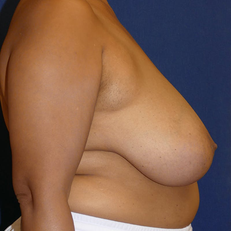 Breast Reduction Before & After Gallery - Patient 564276 - Image 3