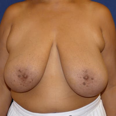 Breast Reduction Before & After Gallery - Patient 564276 - Image 1