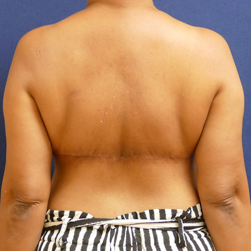 Back Lift Before & After Gallery - Patient 412887 - Image 4